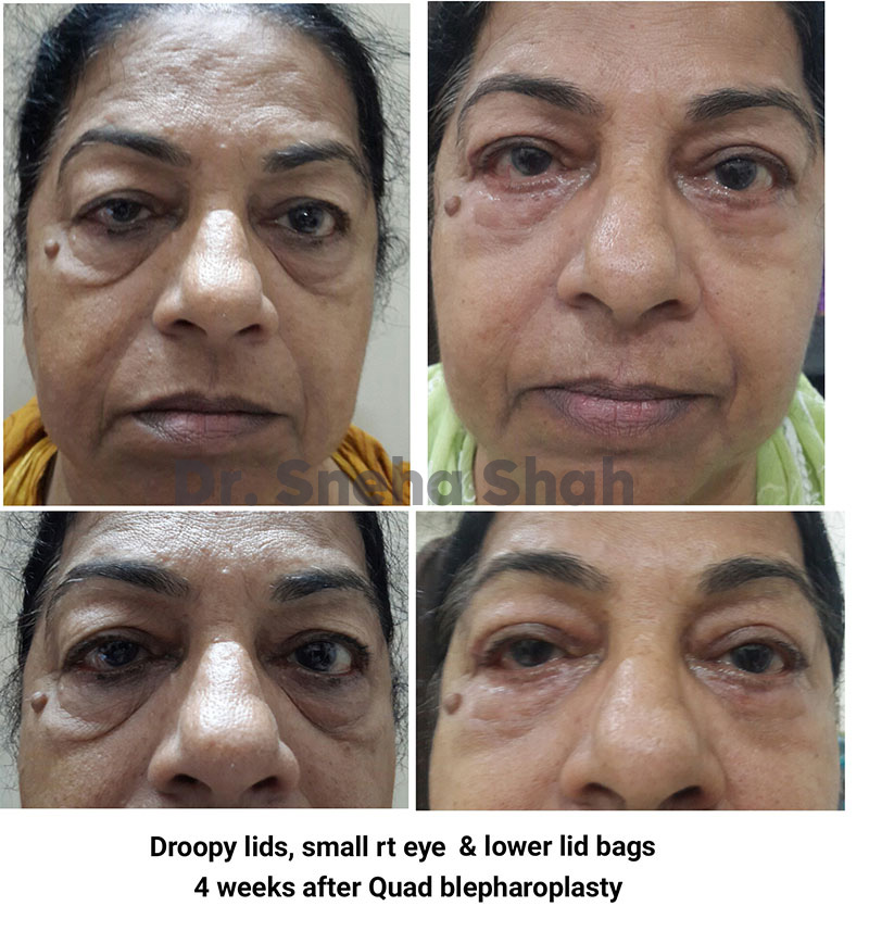  Blepharoplasty -Eyelid Surgery