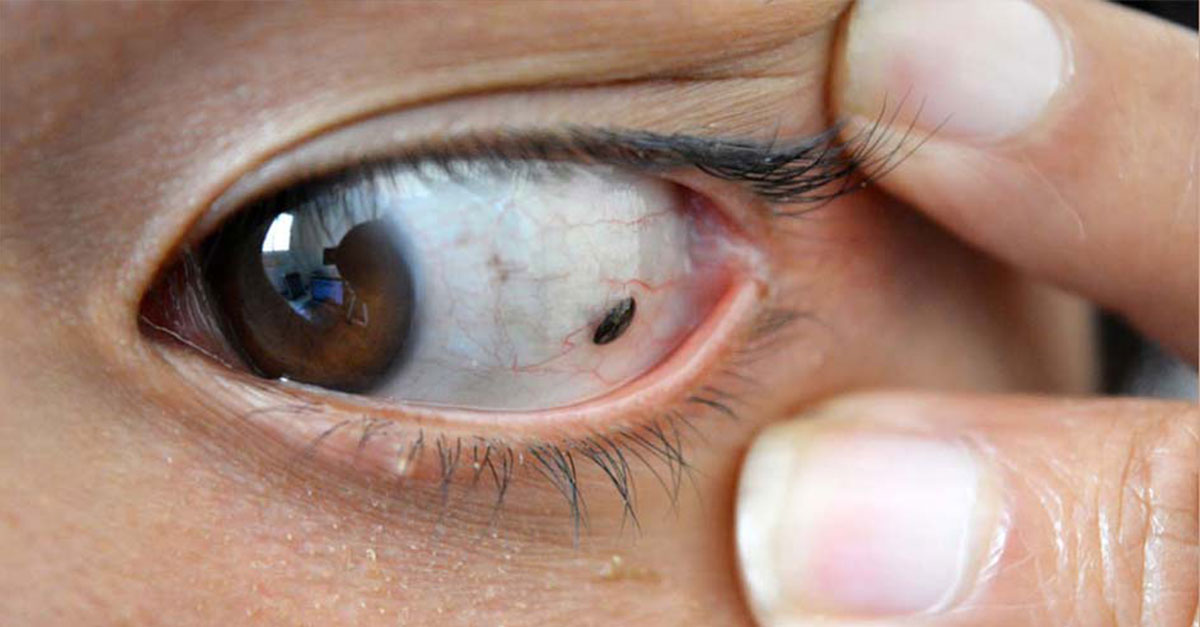  mole on white part Eye Tumors